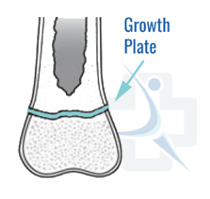 Growth Plate Injuries