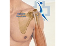 Biceps Tendon Subluxation