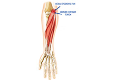 Golfer’s Elbow