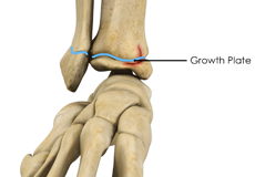 Growth Plate Injuries