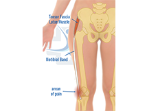 Iliotibial Band Friction Syndrome