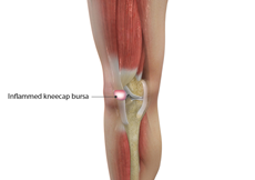 Knee Bursitis