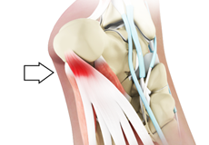 Plantar Fasciitis