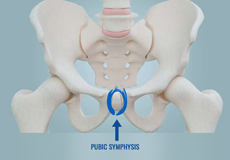 Osteitis Pubis