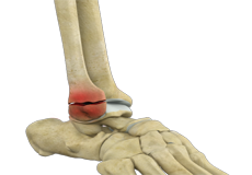 Stress Fracture of the Foot