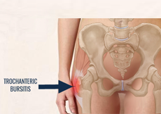 Hip Bursitis (trochanteric bursitis)